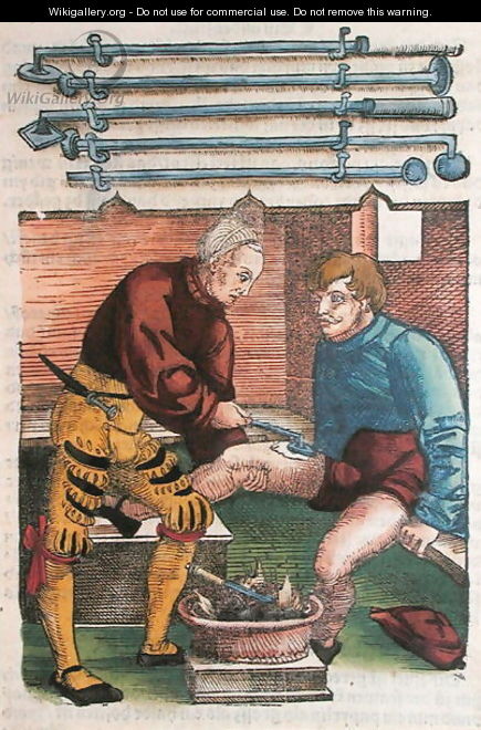 Cauterisation, illustration from Feldtbuch der Wundartzney by Hans von Gersdorff, c.1540 - Hans or Johannes Ulrich Wechtlin