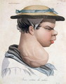 Young Cretin from Valais, illustration from a book by Baron Jean Louis Alibert 1768-1837 - Salvadore Tresca