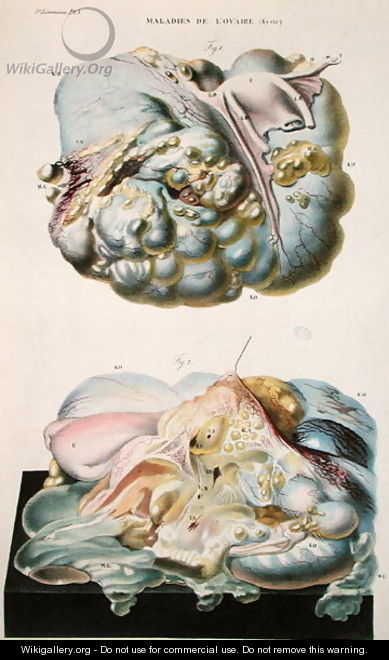 Diseases of the Ovaries, from 