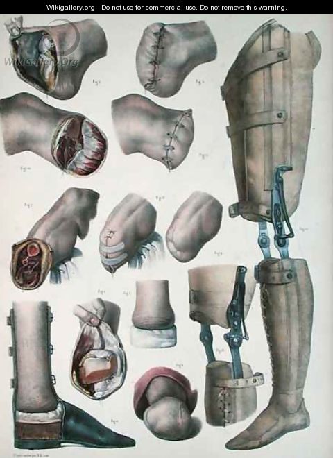 Amputations and Prosthetics - Nicolas Henri Jacob