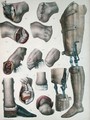 Amputations and Prosthetics - Nicolas Henri Jacob