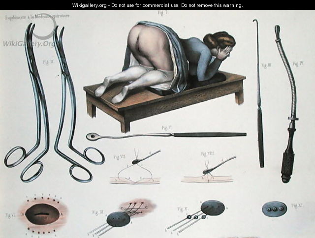 An operation on a vesicovaginal fistula - Nicolas Henri Jacob
