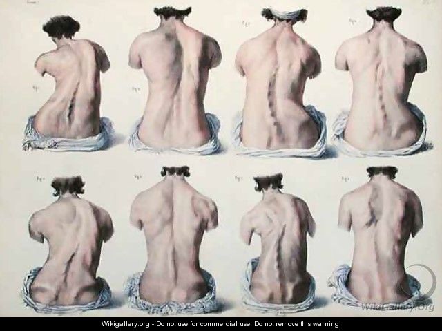 Spinal Deformities - Nicolas Henri Jacob