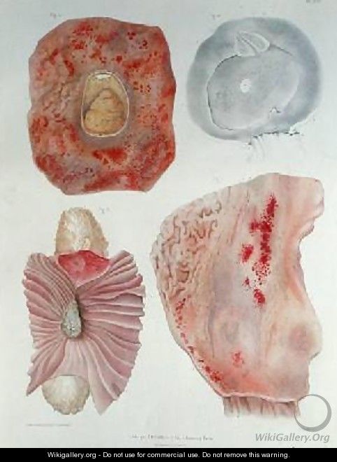 Organs infected with cholera - (after) Lackerbauer