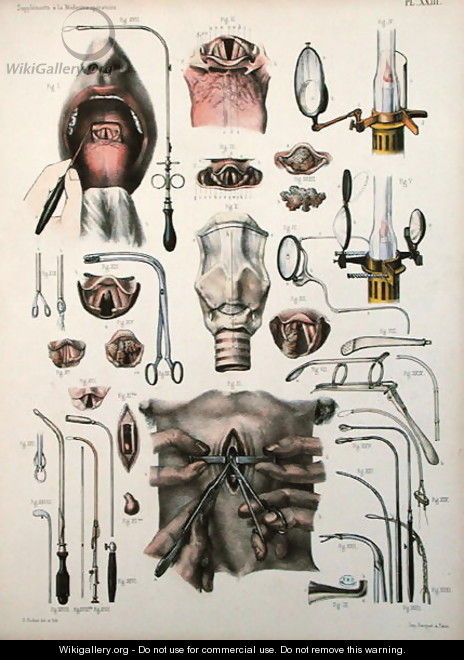 Tracheotomy operation, plate from Traite Complet de lAnatomie de lHomme by Jean-Baptiste Marc Bourgery 1797-1849 1866-67 - E. Pochet