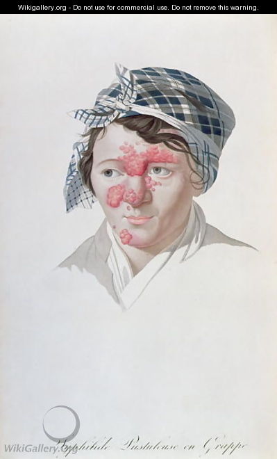 Syphilic cluster pustules, from a book by Baron Jean Louis Alibert 1768-1837 1838 - Salvadore Tresca
