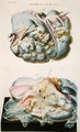 Diseases of the Ovaries, from 'Anatomie Pathologique du Corps Humain' - Antoine Chazal