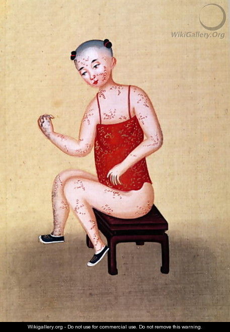 Child with smallpox (2) - Anonymous Artist
