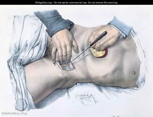 Tying up an artery - Nicolas Henri Jacob