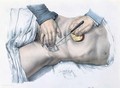 Tying up an artery - Nicolas Henri Jacob