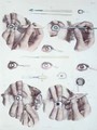 Operation on a eye - Nicolas Henri Jacob