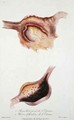 Softening and follicular ulcers of the stomach, from 'Traite des Maladies des Enfans Nouveaux-Nes et a la Mamelle' - (after) Billard, Charles-Michel